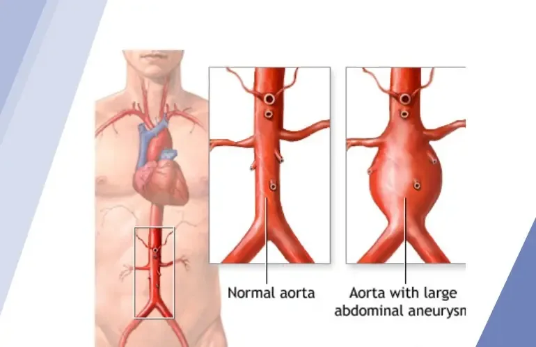 Aortic Aneurysm Causes Symptoms Diagnosis and Treatment