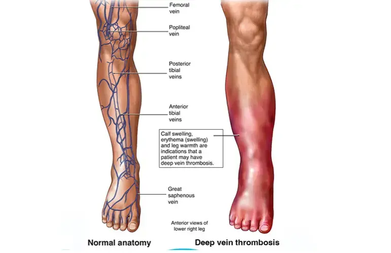 Dialysis Access: Types, Procedures and Treatment