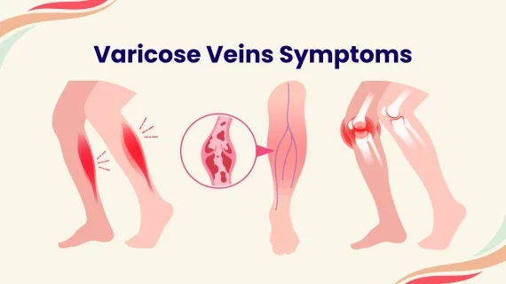 Varicose Veins Causes Symptoms Best Treatment Options