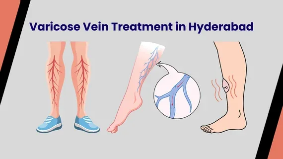 Varicose Vein Treatment: Advanced Care for Healthy Legs