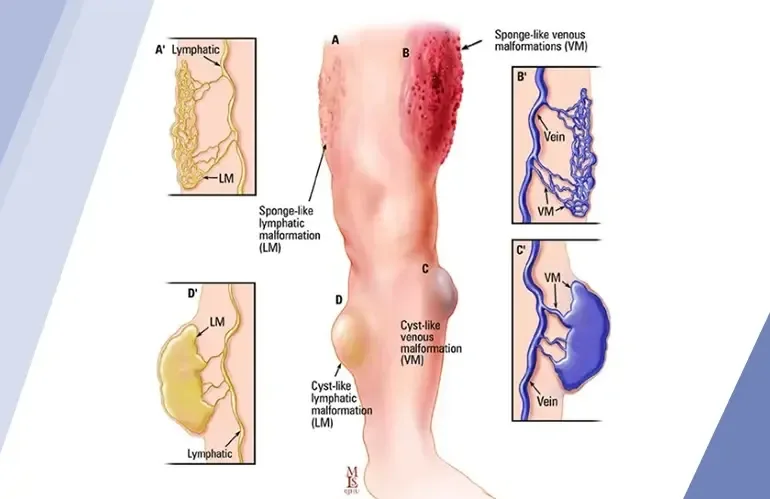 Vascular Malformations Causes Symptoms and Treatment